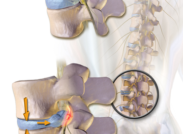 فيديو -علاج الانزلاق الغضروفي وقطع الغضروف الهلالي بالركبة كتاب اطلس الحجامة المقطع كامل